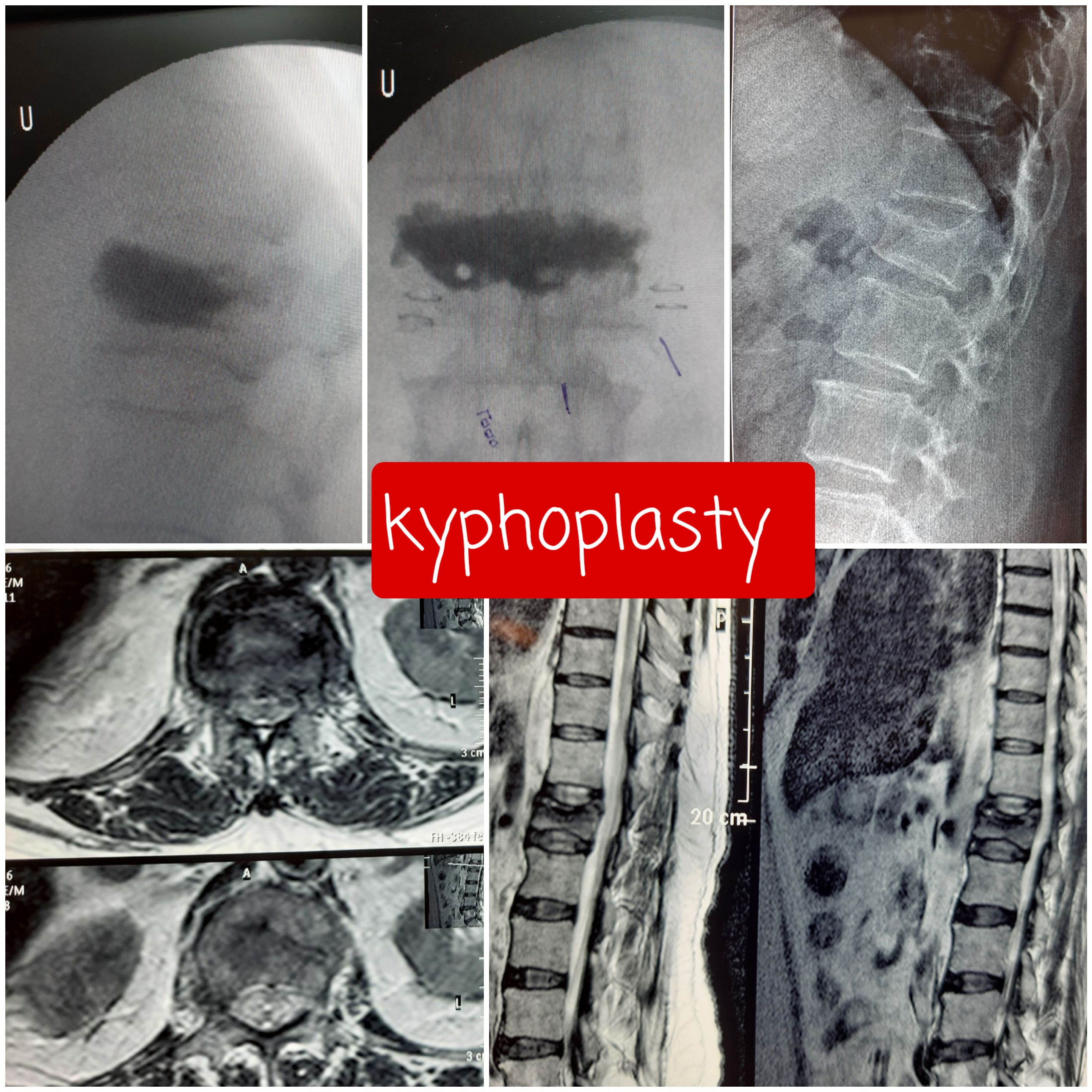 Cervical Disc