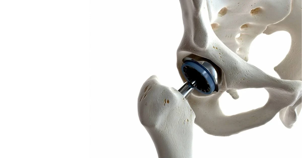 Hip replacement Surgery