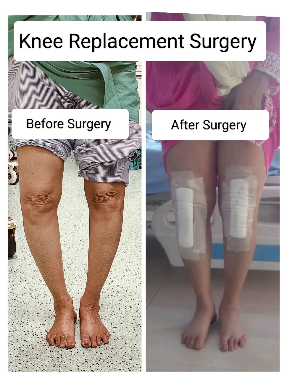 It Represents Knee Replacement Surgery Before After